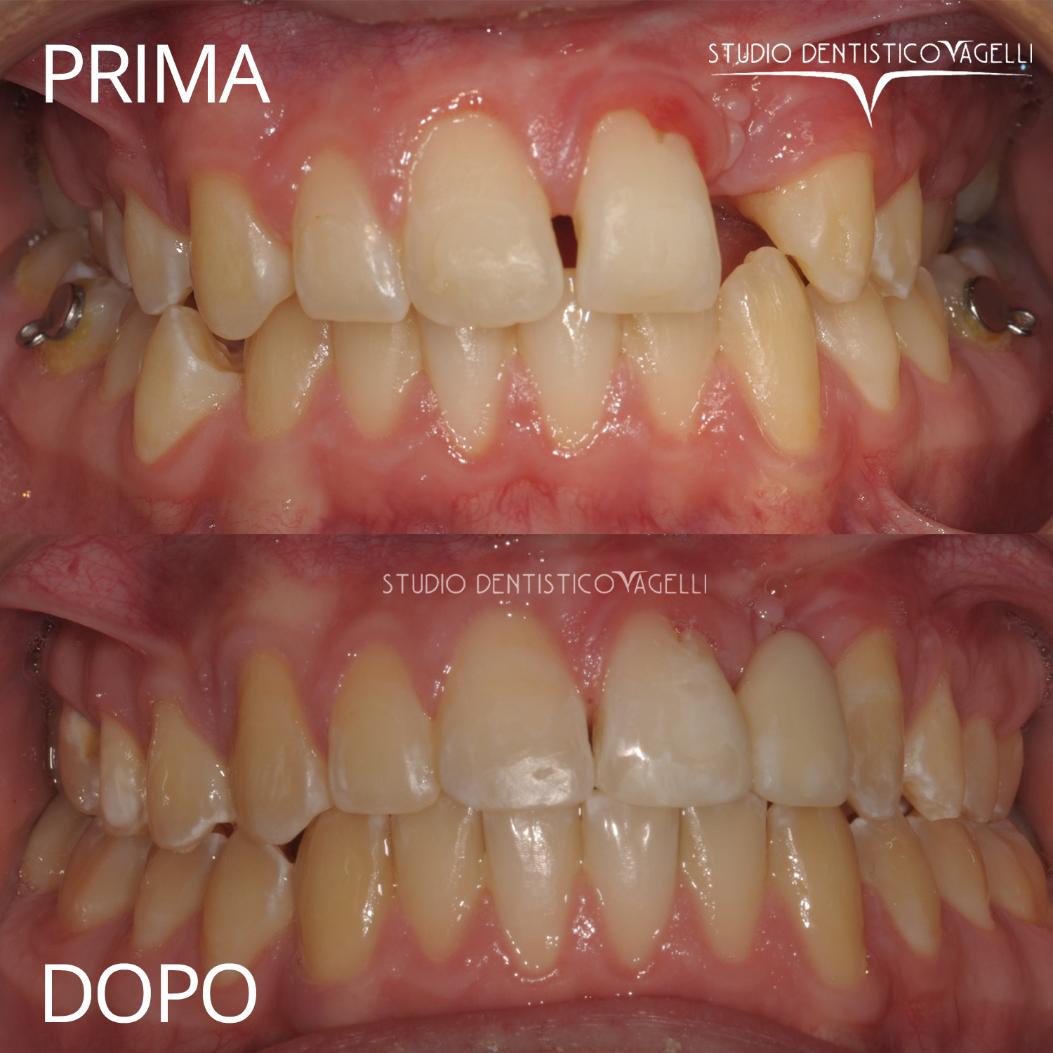 vagelli-prima-dopo-2