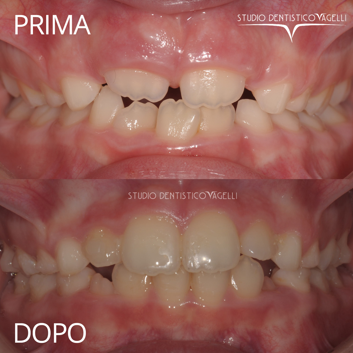 vagelli-prima-dopo-4